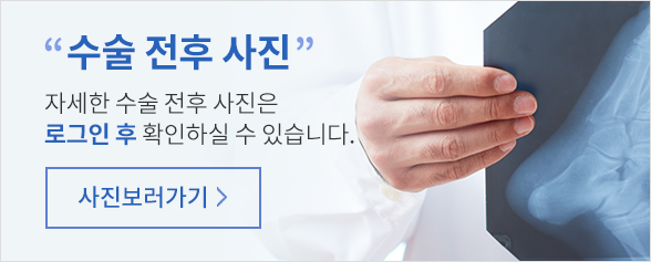 무지외반증 수술전후 사진 바로가기